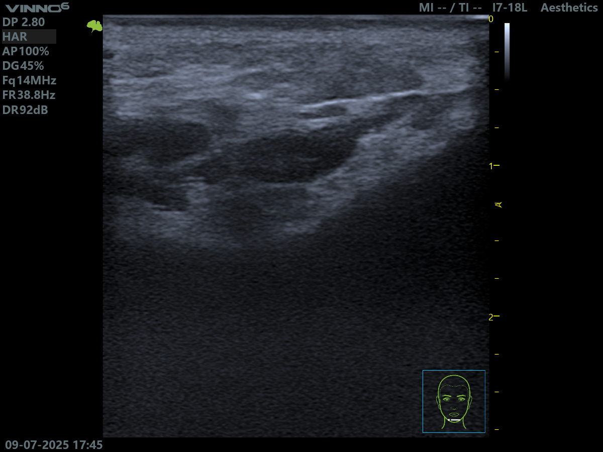 Chin After Injection