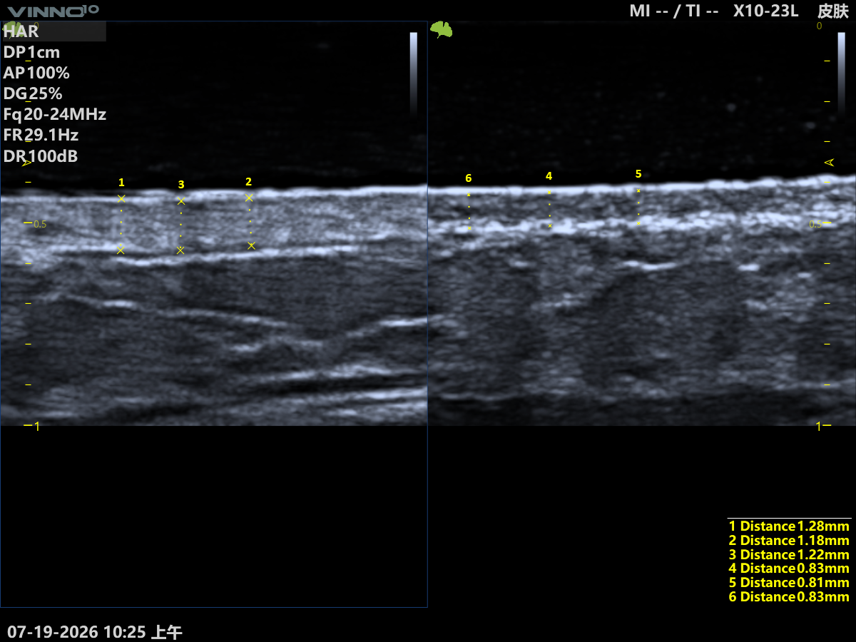 Dermis Thickness