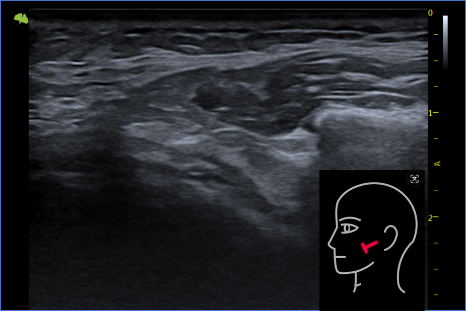 Masseter Muscle