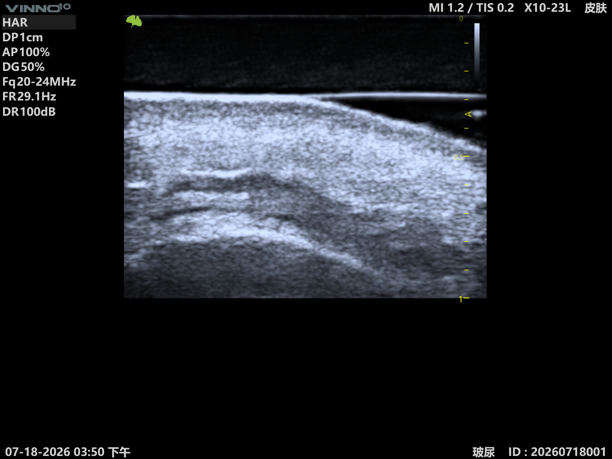Epidermis & Dermis