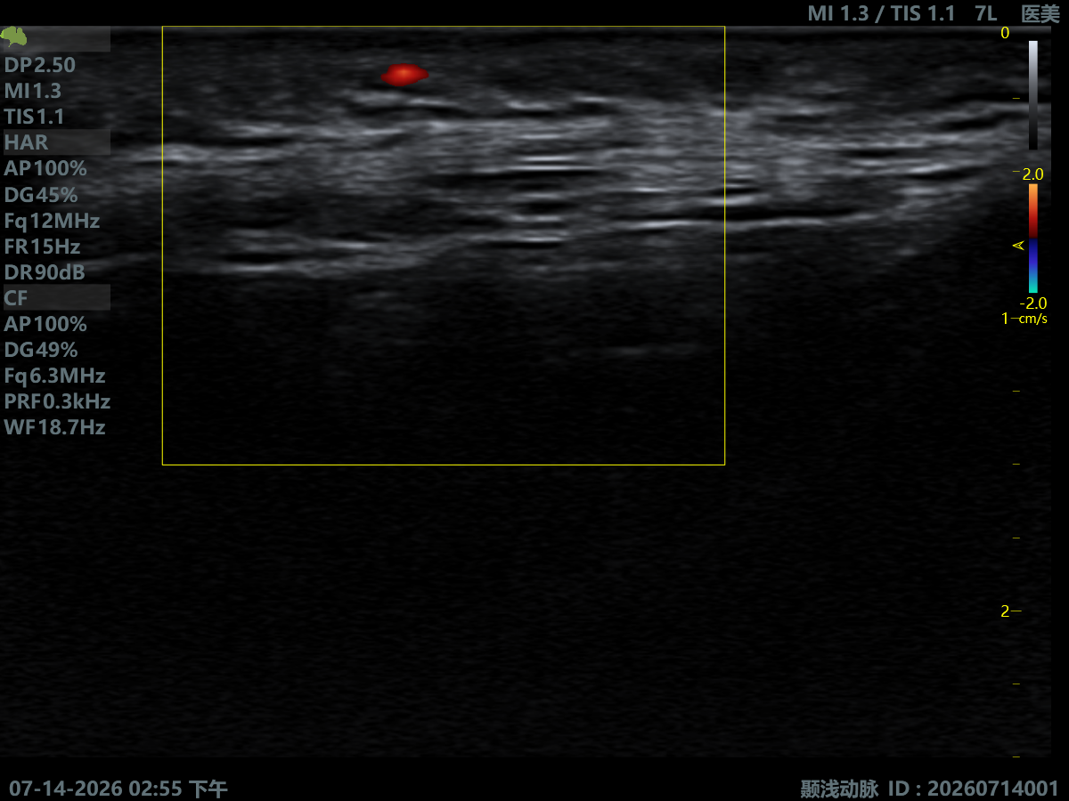 Superficial Temporal Artery