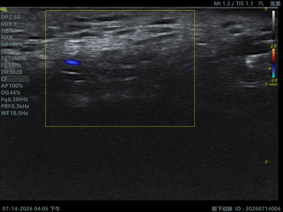 Infraorbital Artery