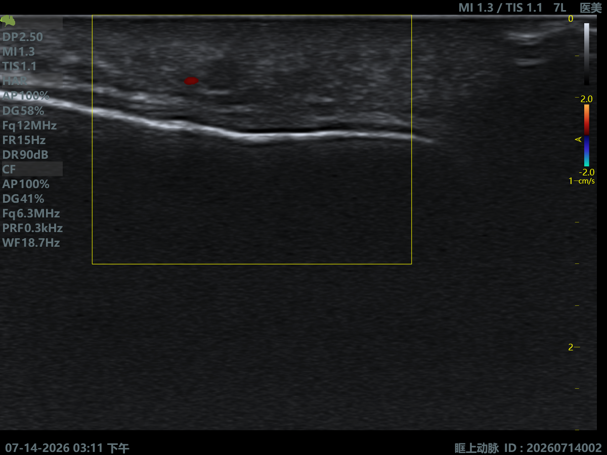 Supraorbital Artery