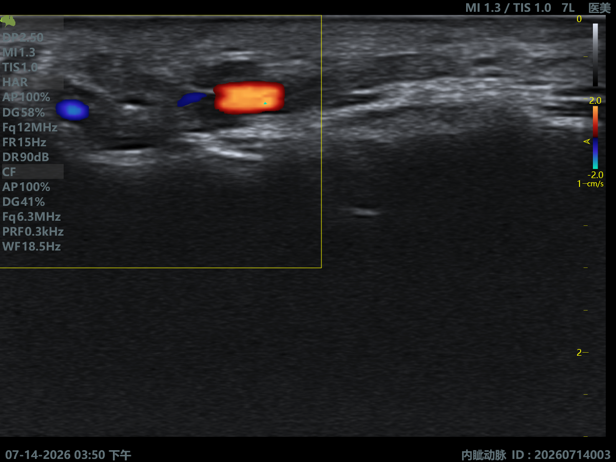 Angular Artery & Vein