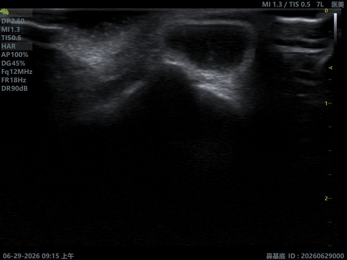 Nasal Base