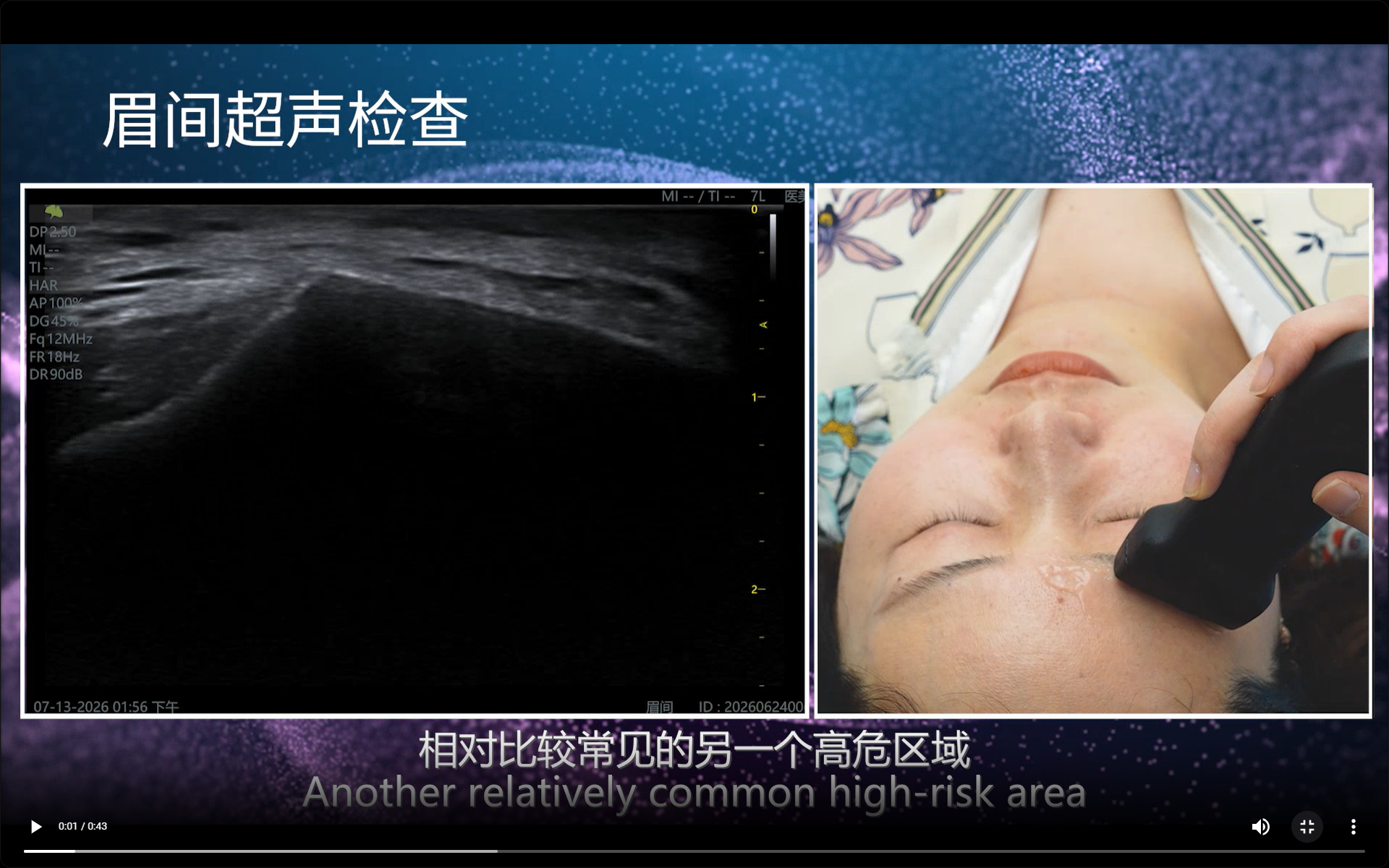 Glabella