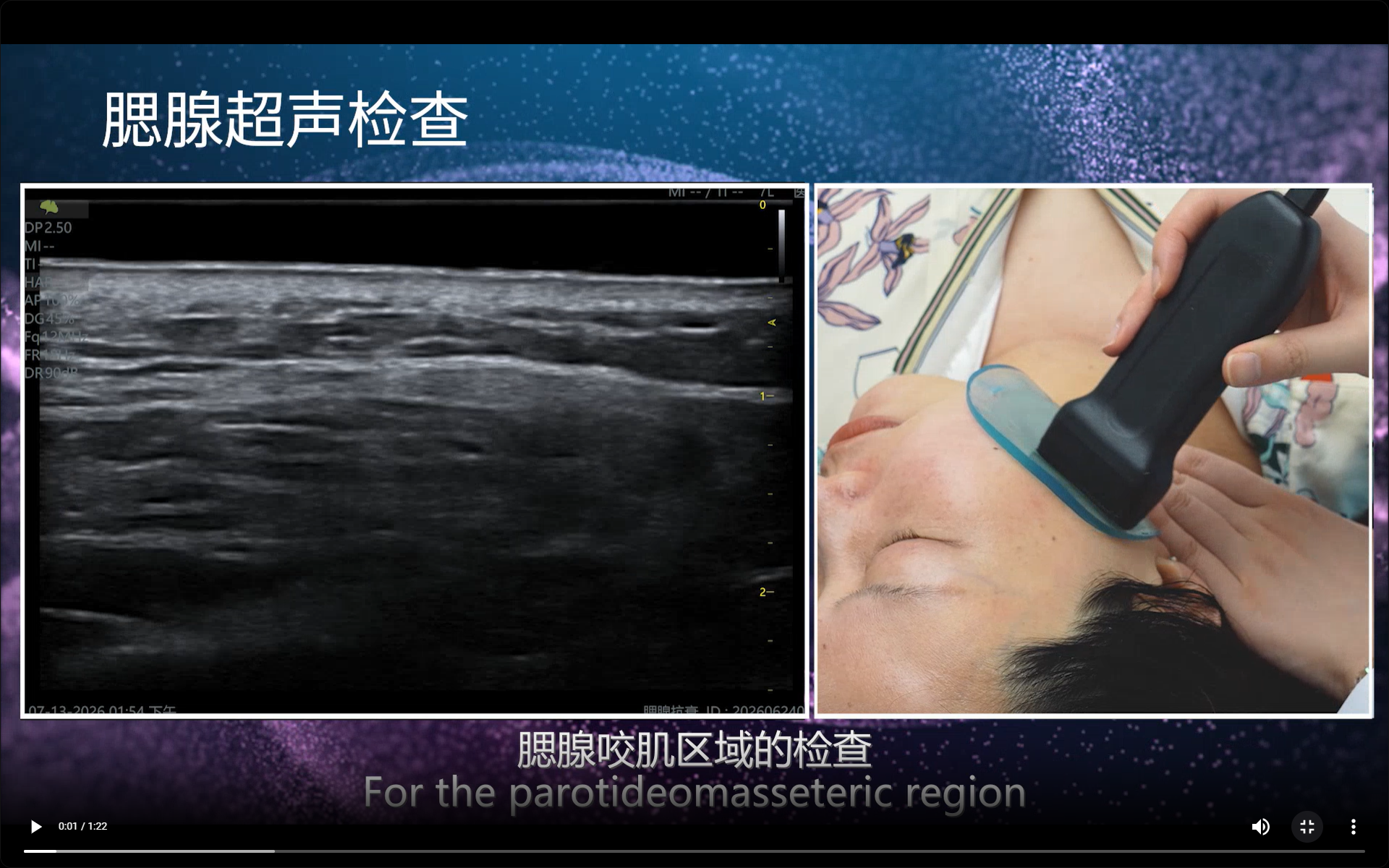 Parotid Gland
