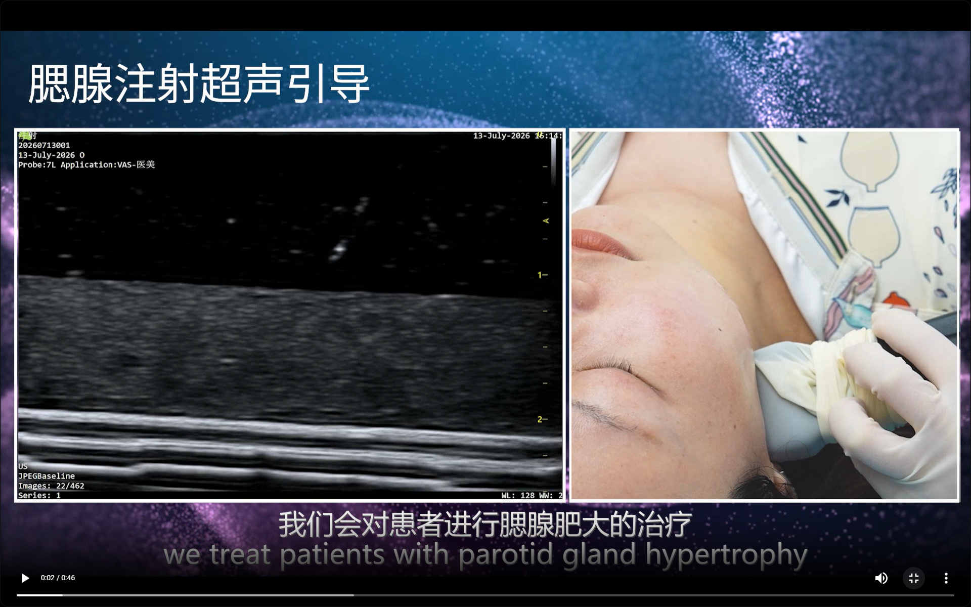 Parotid Injection