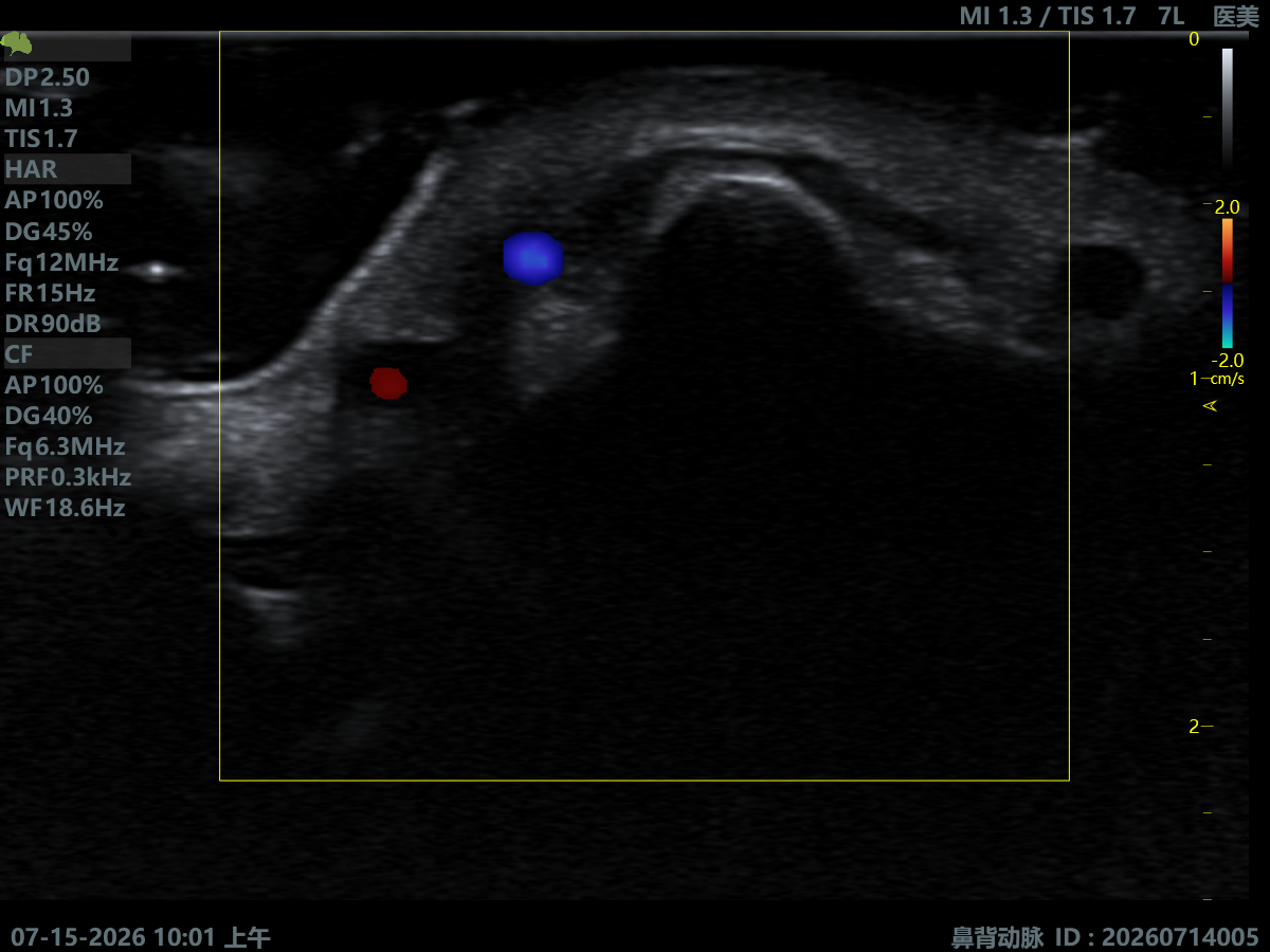 Dorsal Nasal Artery
